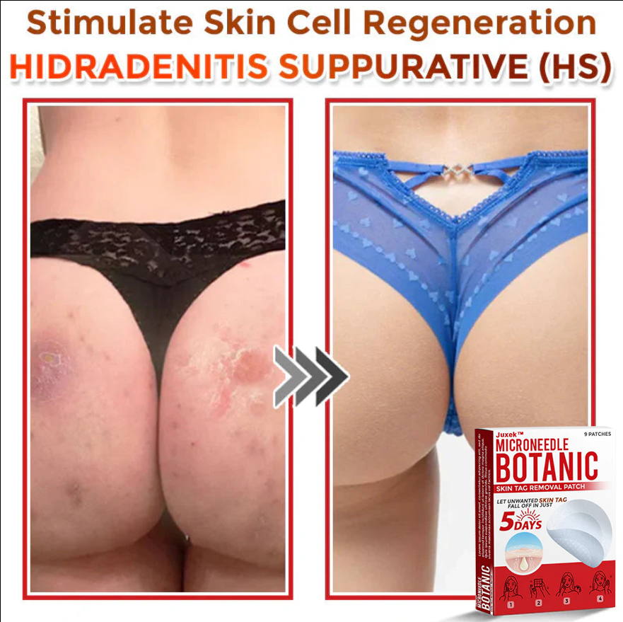 Juxek™ Removal Patch: Gentle Microneedle Patches for Skin Tag & Mole Removal