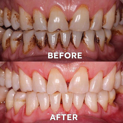 ✅For the treatment of periodontitis and oral ulcers, prevention of tooth loss, and repair of gum recession