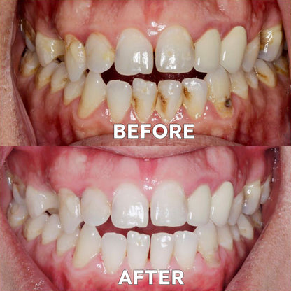 ✅For the treatment of periodontitis and oral ulcers, prevention of tooth loss, and repair of gum recession