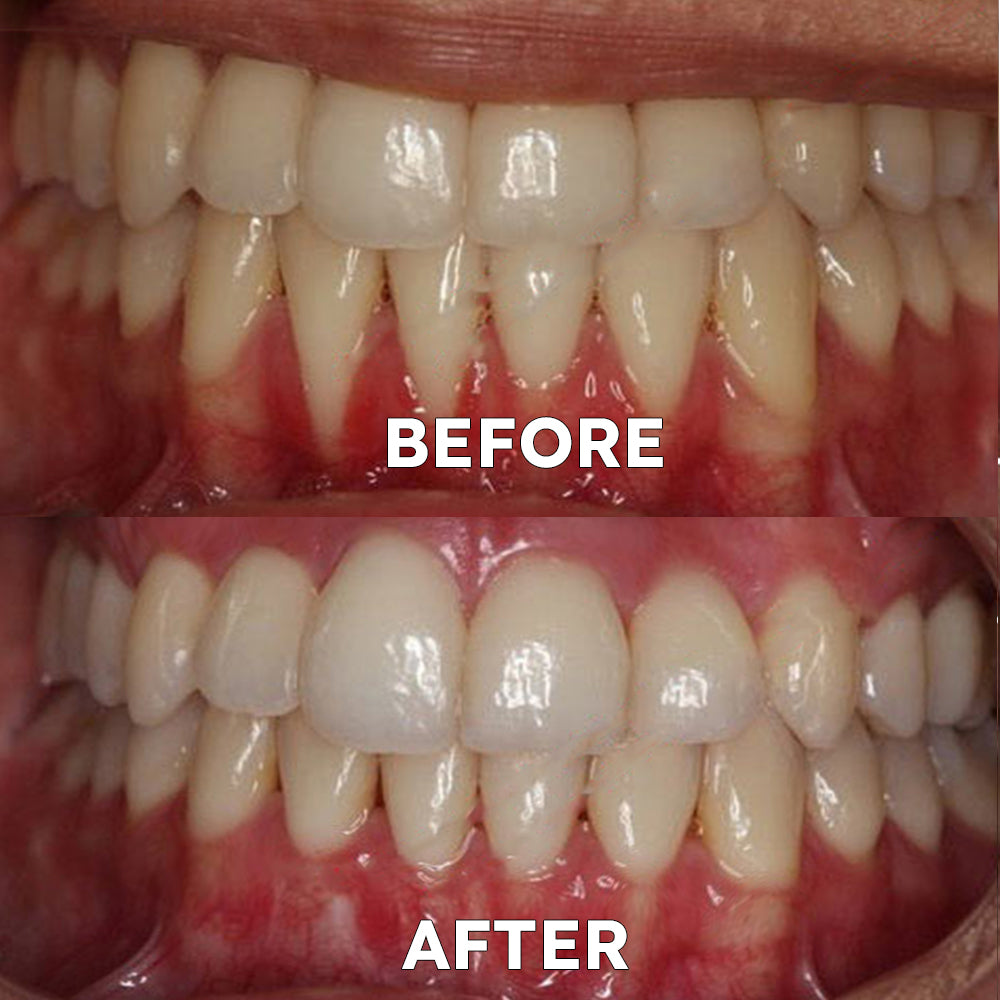 ✅For the treatment of periodontitis and oral ulcers, prevention of tooth loss, and repair of gum recession